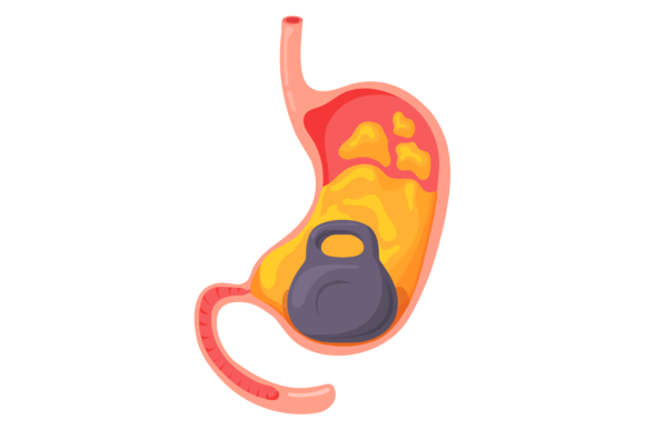 Heavy Stomach Syndrome. Cartoon Medical